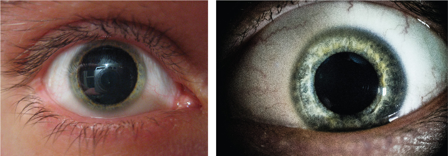This photograph shows a person’s eye with a relatively large pupil.