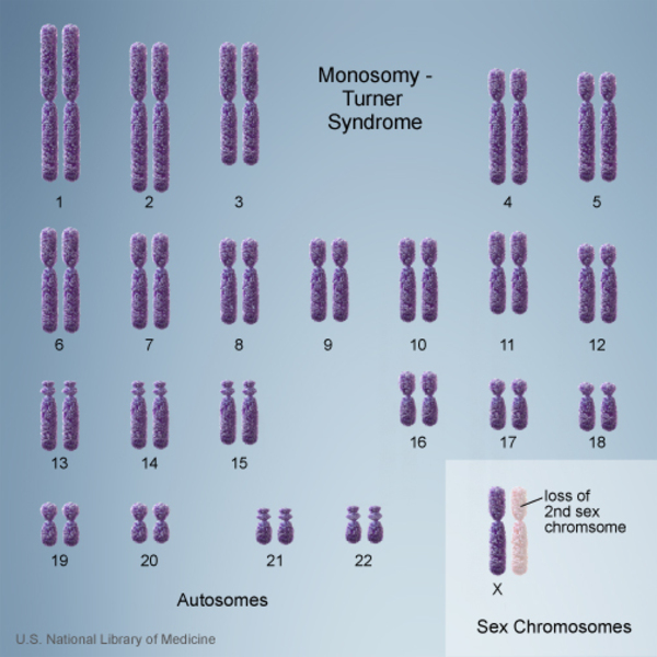 A karyotype showing a form of monosomy called Turner syndrome, in which the second sex chromosome is missing.