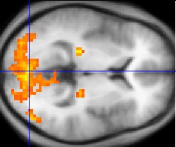 A functional magnetic resonance image. Yellow indicates the regions of increased activity.