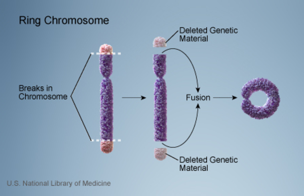 A ring chromosome occurs when the two ends of a chromosome break and then fuse together, creating a ring shape.