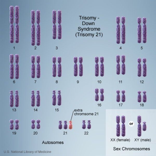 A karyotype showing an extra copy of chromsome 21, for a total of 47 chromosomes instead of the usual 46.