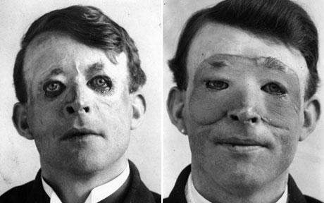 Walter Yeo, before and after the first plastic surgery