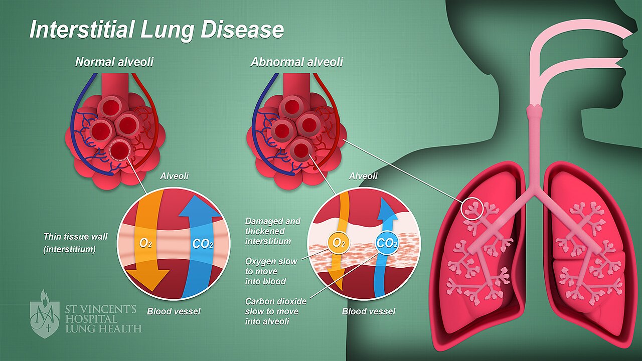 Figure 1. Interstitial Lung Disease