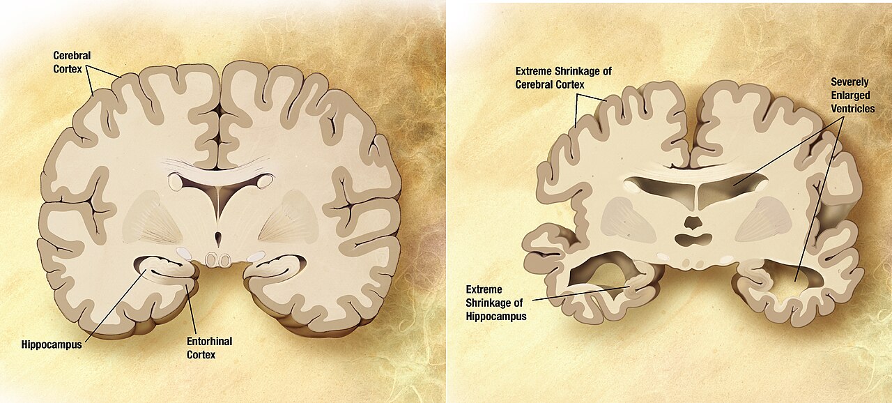 Comparison of a healthy brain and a brain with alzheimers. 2