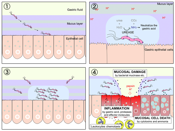Diagram of Helicobacter Pylori Causing Stomach Ulcers