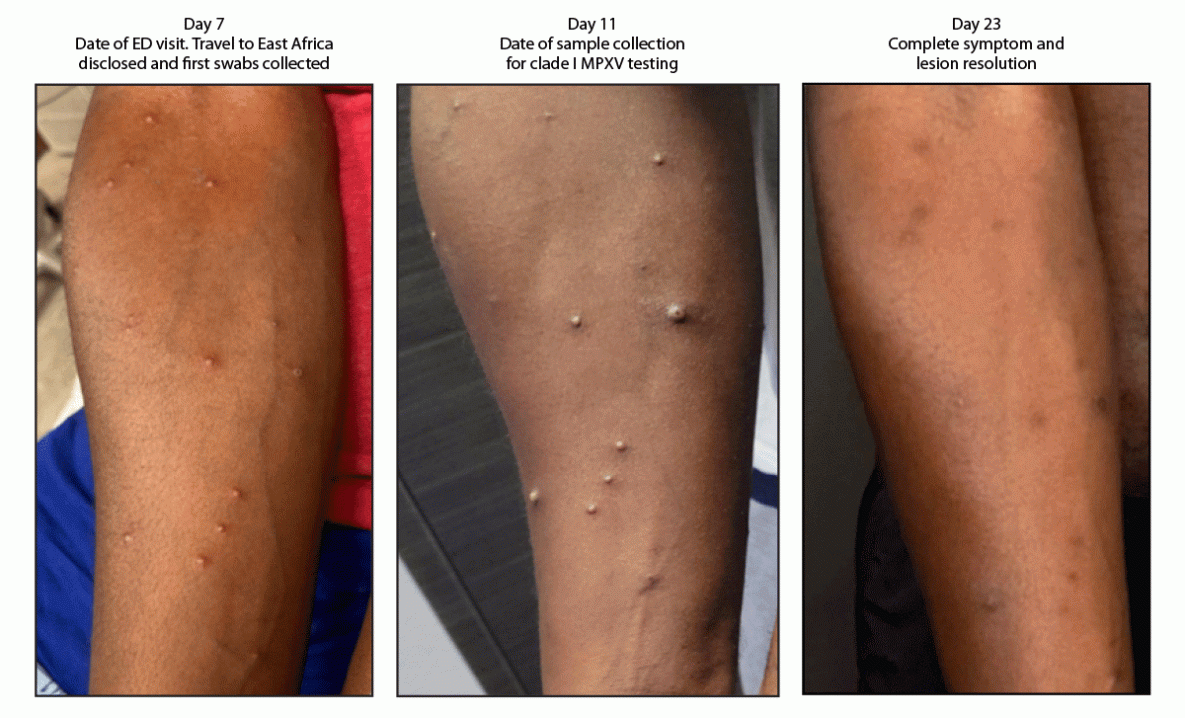 Lesions on the forearm on days 7, 11 and 23
