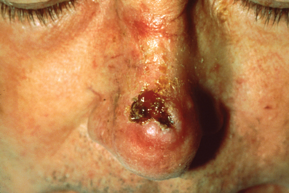 A lesion on the side of a person’s nose