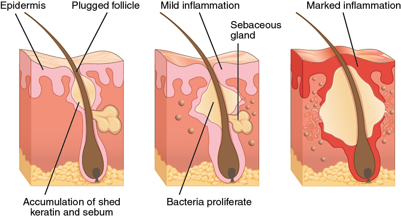 Three diagrams showing a hair follicle becoming blocked and inflamed