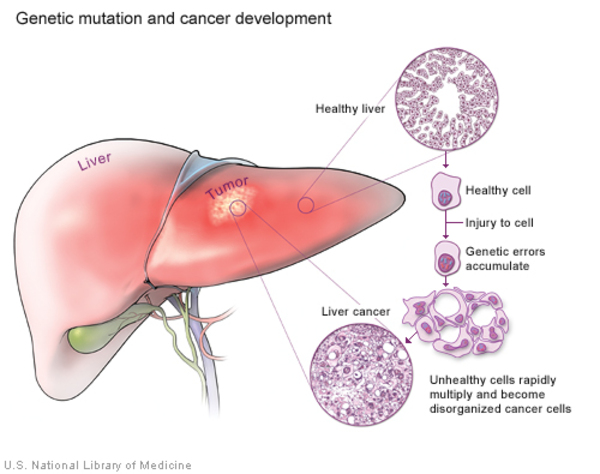A tumor in the liver; inset shows the progression from a normal cell to one in which genetic changes accumulate, leading to rapid and disorganized cell division.