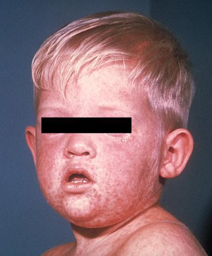 A boy's face on the third day of the rash