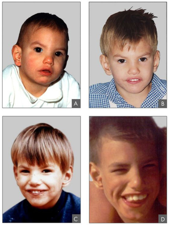 Photos show a boy with cri-du-chat syndrome. In parts a, b, c, and d of the image, he is two, four, nine, and 12 years of age, respectively.